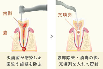 虫歯菌が感染した歯質や歯髄を除去、患部除去・消毒の後、充填剤を入れて密封